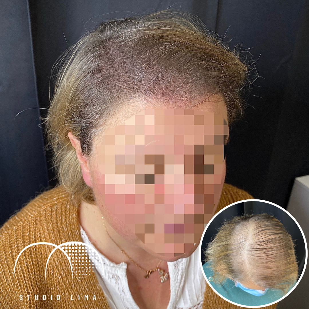 tricopigmentation-effet-densité-femme-albi