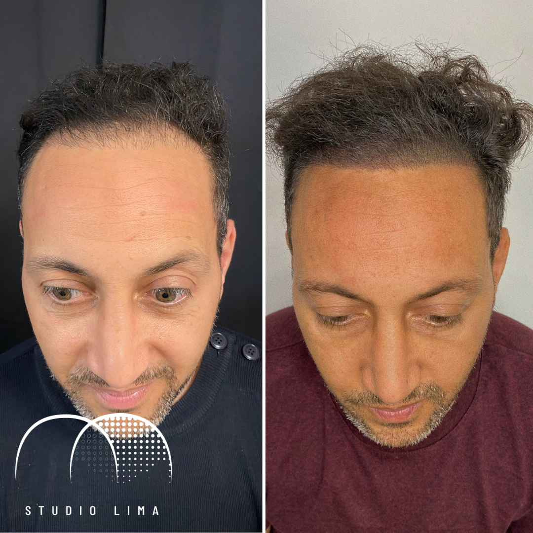 Tricopigmentation, solution contre la chute de cheveux et la calvitie à Albi dans le Tarn